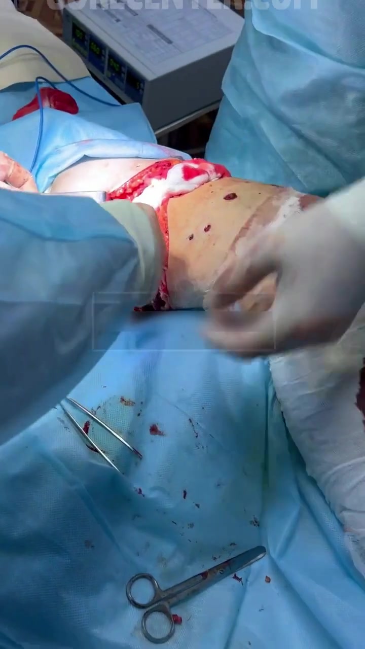 Ампутация ноги.