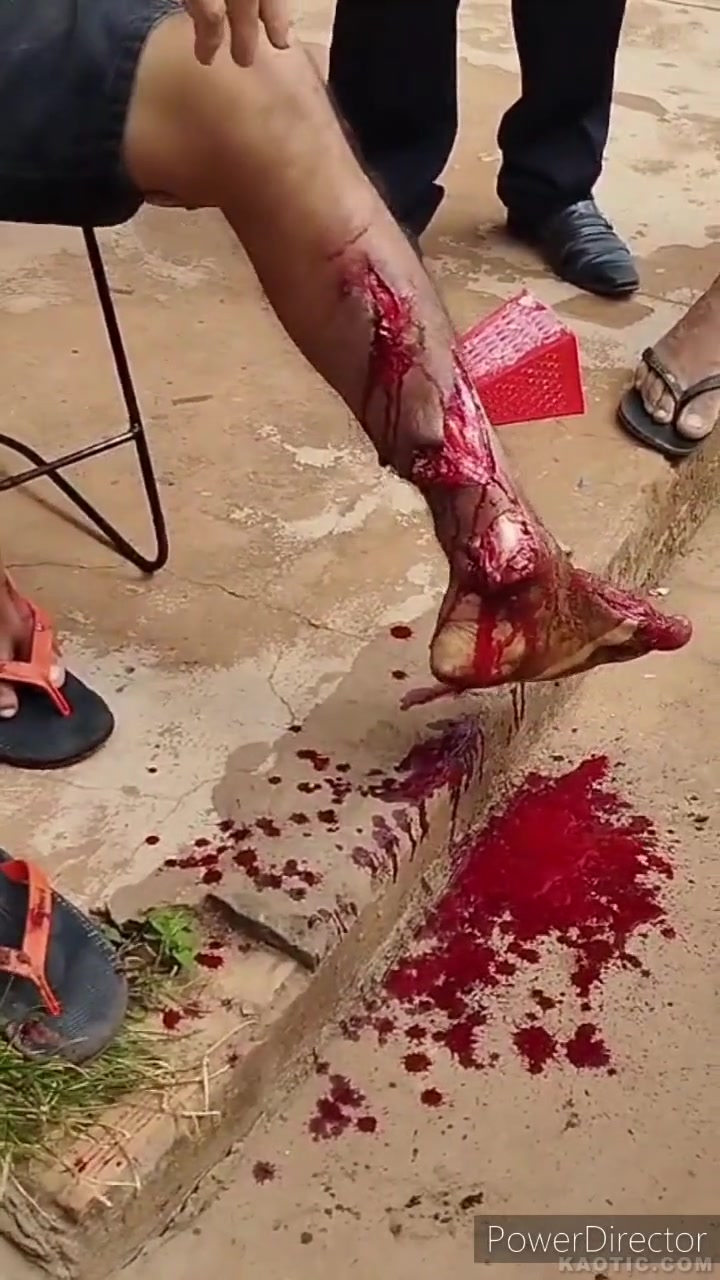 Авария, плоская стопа.